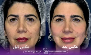 تصویر خانمی بعد از هایفوتراپی که صورت ایشانبسیار بانشاط و جذاب شده است