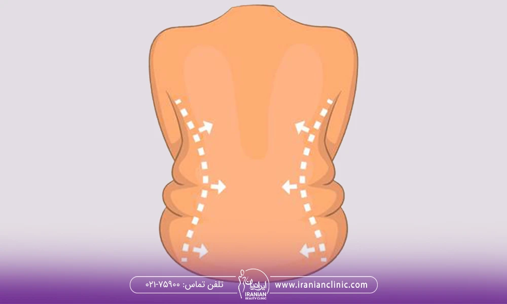 عکس از چربی اضافه پهلو