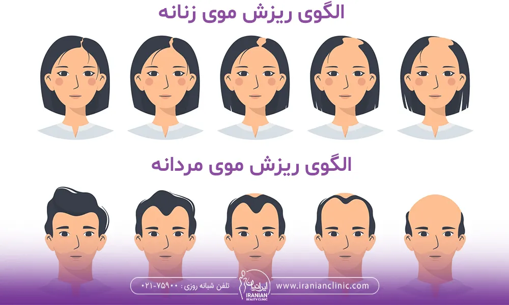 الگوی ریزش مو در زنان و مردان 