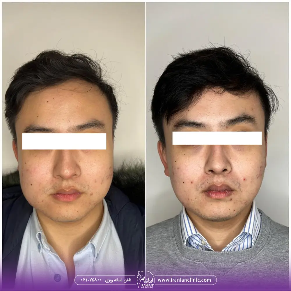 عکس قبل و بعد لاغری صورت مرد