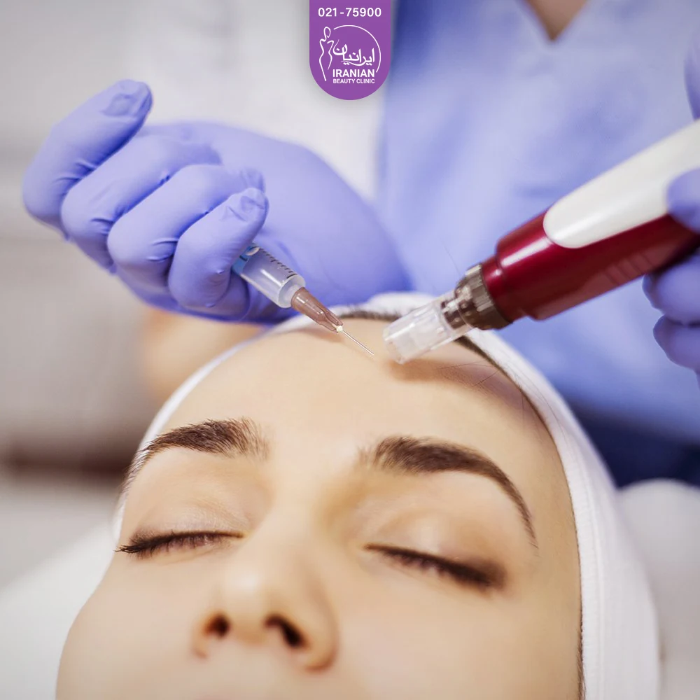 مزوتراپی پیشانی دختر توسط پزشک با میکرونیدلینگ و آمپول مزو - مزوتراپی صورت