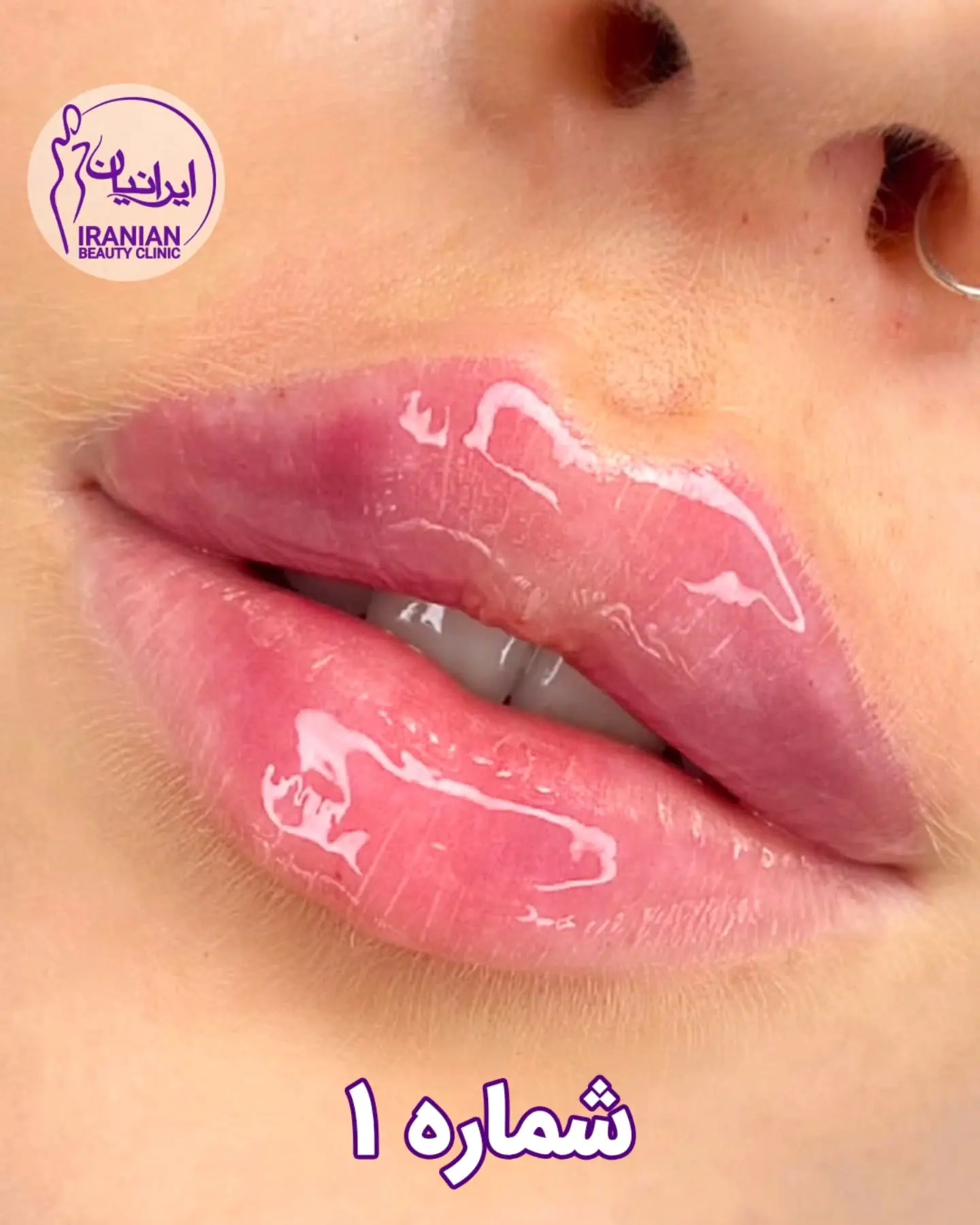 نمونه تزریق ژل لب در کلینیک زیبایی ایرانیان