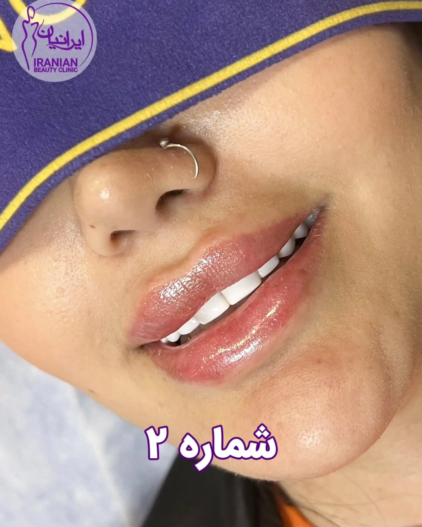 عکس تزریق فیلر لب در کلینیک زیبایی ایرانیان - تزریق ژل لب