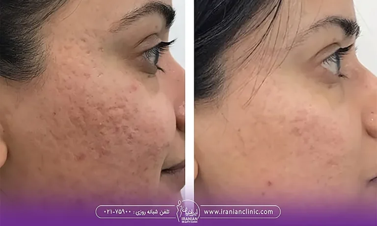 فیلم قبل و بعد میکرونیدلینگ