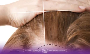 Hair-mesotherapy-with-the-device