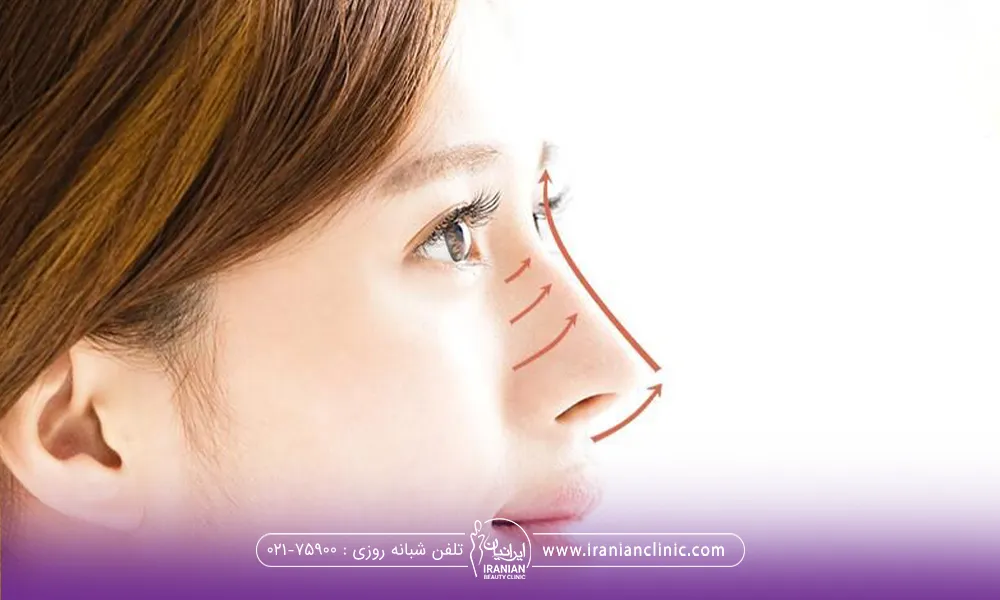 خانومی که لیفت بینی با نخ انجام داده است و از نیمرخ عکس گرفته است