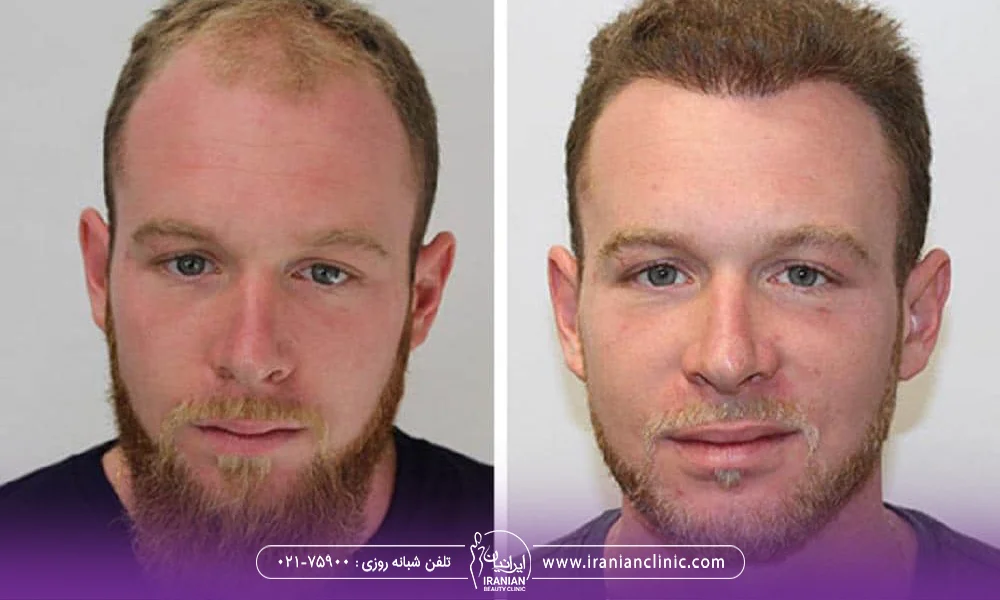 عکس قبل و بعد کاشت مو و نتایج پیوند