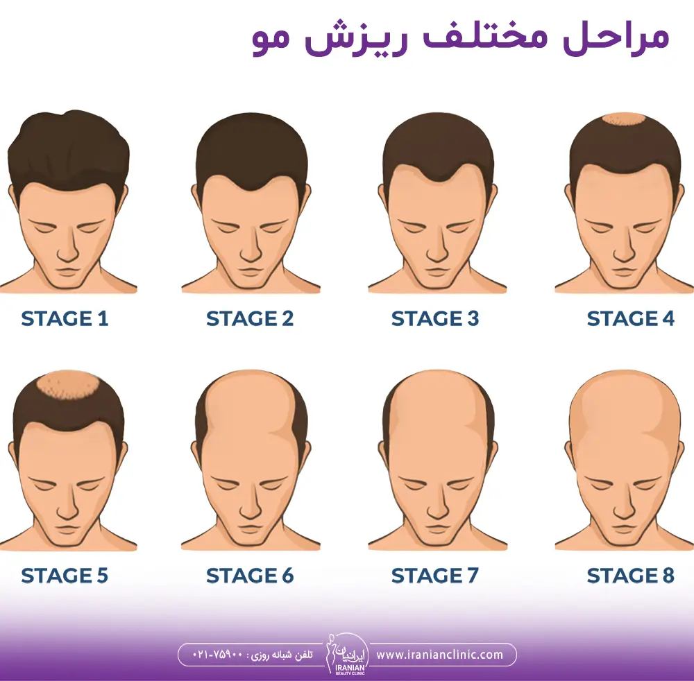 مراحل ریزش مو در الگوی ریزش مردانه