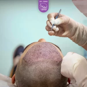 تصویر پزشک در حال کاشت مو در کلینیک ایرانیان - دپارتمان کاشت