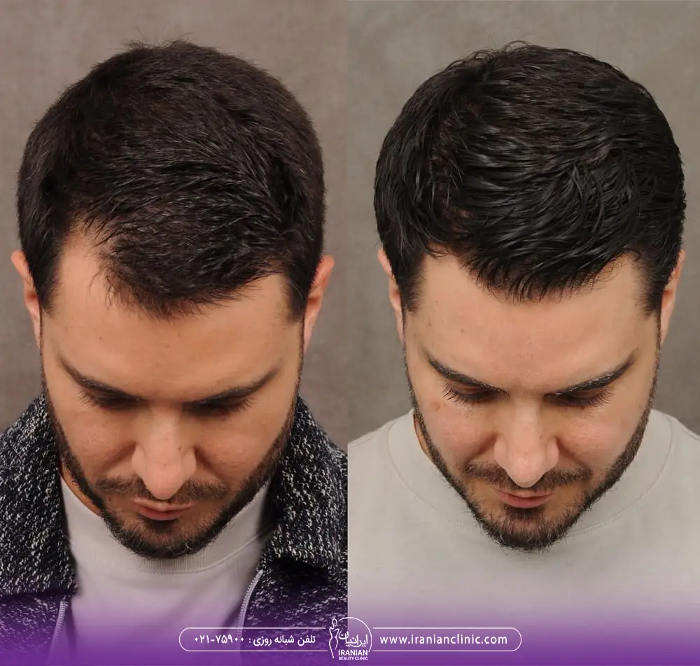 تصویر نمونه کار کاشت مو قبل و بعد