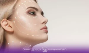 Does hifu make the face slim