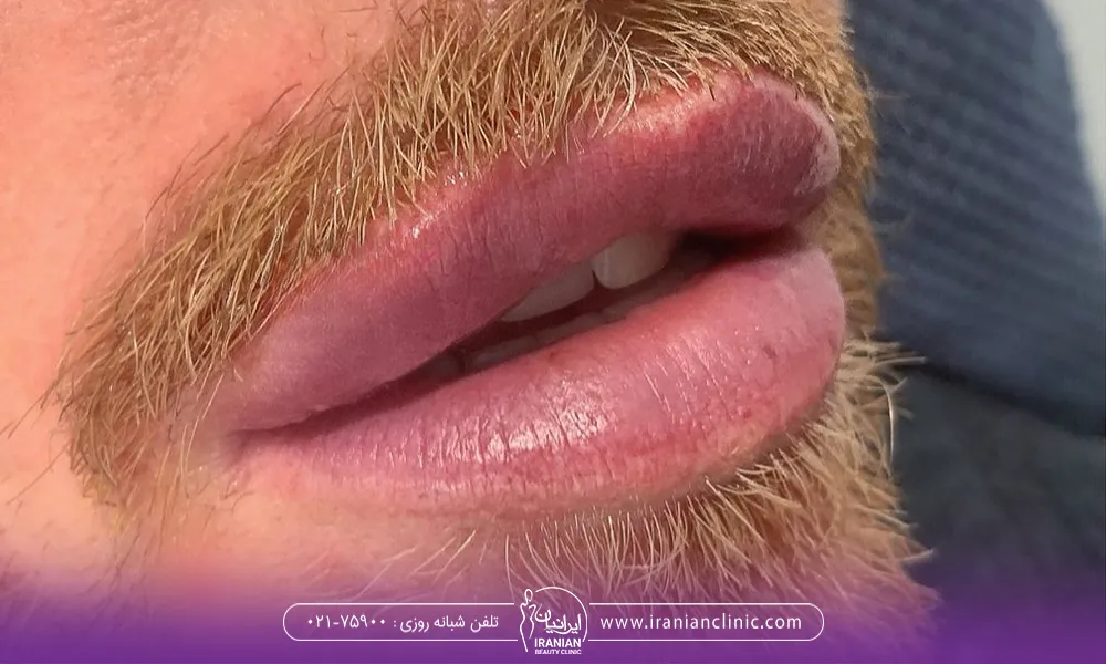 آقایان هم می توانند از از خدمات تزریق ژل لب مردانه استفاده کنند.