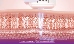 هایفو در مقابل سایر روش های پیکرتراشی بدن