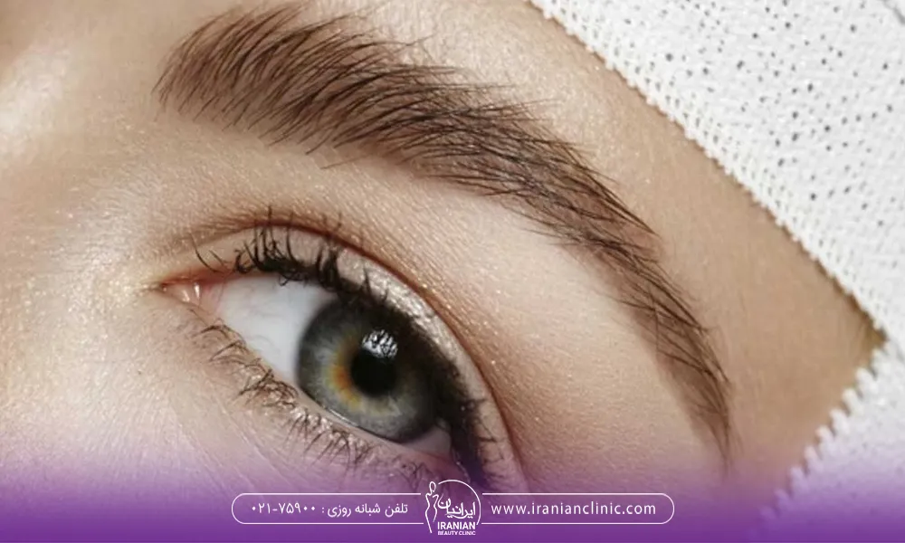 آشنایی با دلایل ریزش ابرو بعد عمل کاشت ابرو