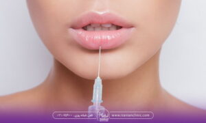 مواردی بر روی ژل تزریقی لب تاثیر می گذارند .