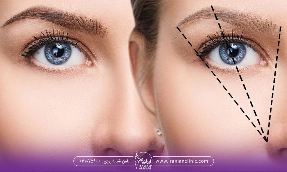 ماندگاری ابرو های کاشته شده به چه عواملی بستگی دارد ؟