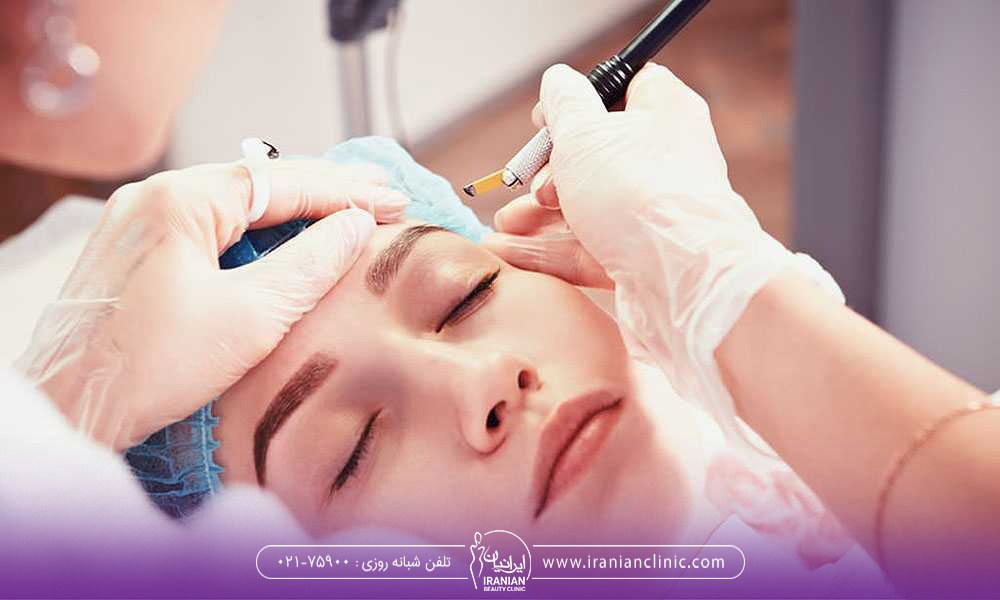 کدام روش کاشت ابرو دائمی است ؟