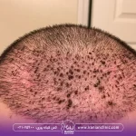 تصویر ورم بعد از کاشت مو