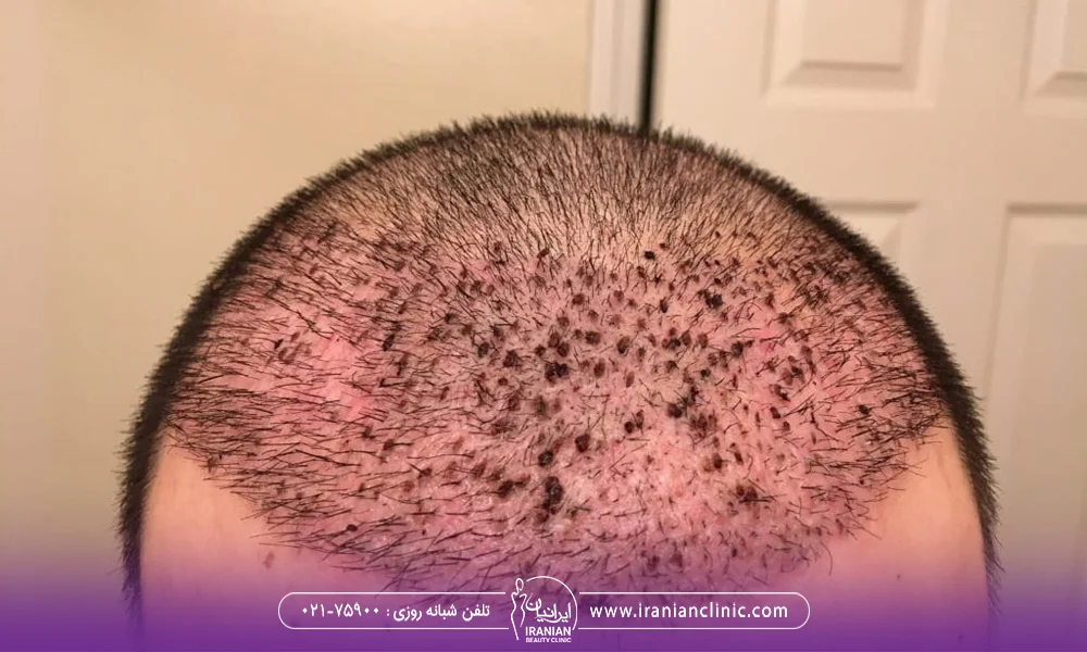 تصویر ورم بعد از کاشت مو