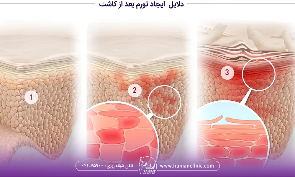 دلیل ورم بعد از کاشت مو چیست
