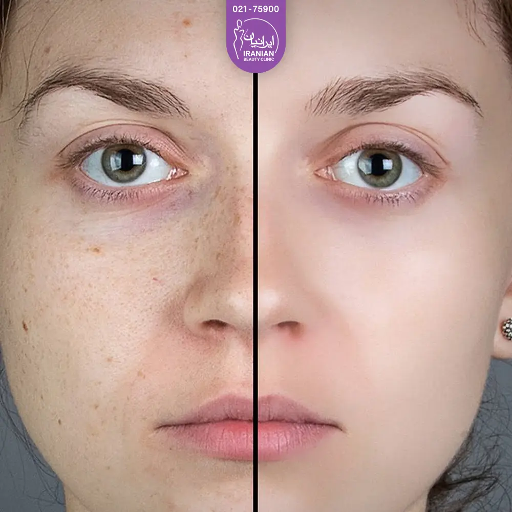 عکس از قبل و بعد لایه برداری پوست صورت با face up - فیس آپ