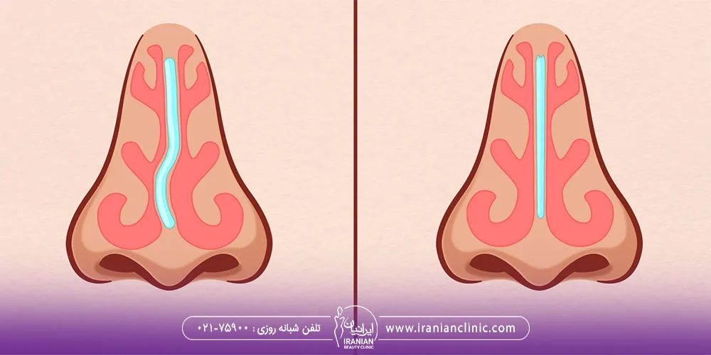 انحراف بینی چیست
