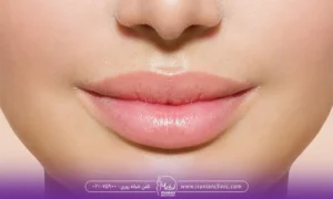 تزریق ژل لب