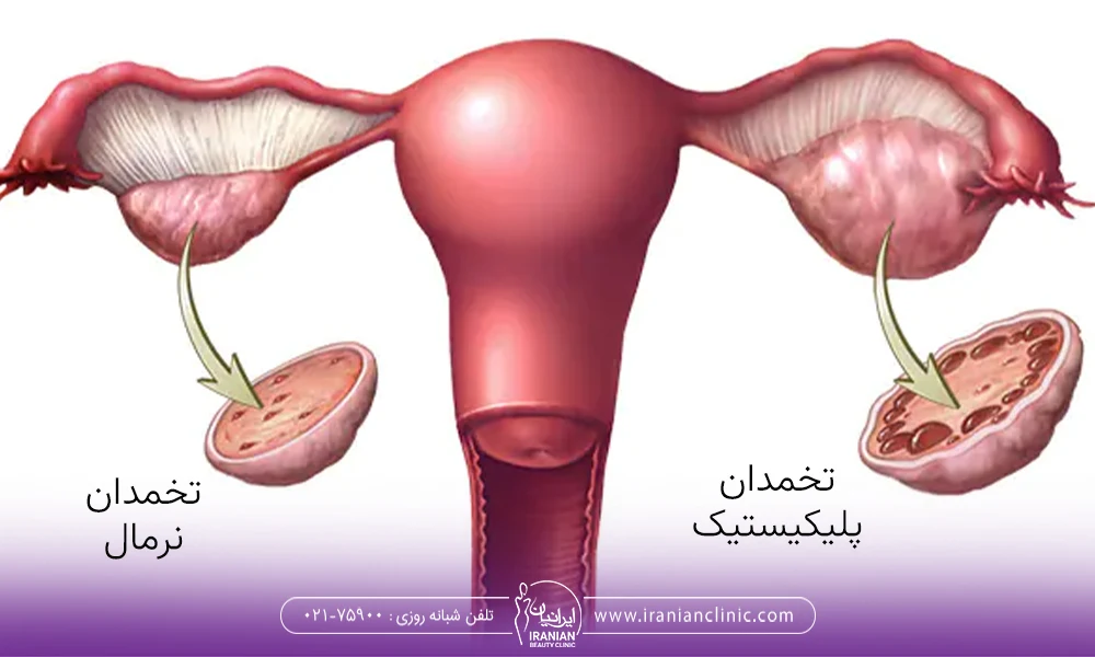 تخمدان پلی کیستیک