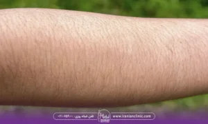 موهای دست - ماندگاری لیزر موهای زائد