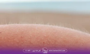 موهای سفید کوچک روی پوست