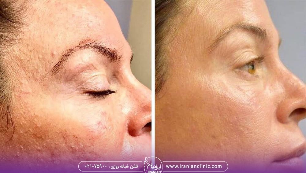 عکس مربوط به تاثیر میکرو نیدلینگ و پماد زینک اکساید هست