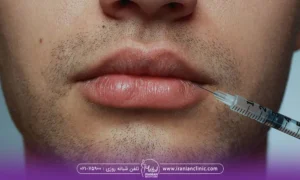 یک آقا که توسط دکتر تزریق ژل به ناحیه لب انجام میدهد