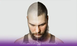 قبل و بعد آقایی که مو کاشته است