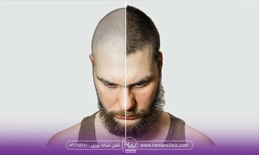 قبل و بعد آقایی که مو کاشته است