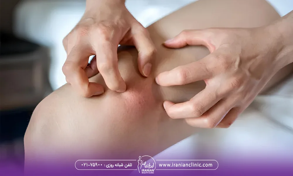عکس جوش روی پا - جوش زدن بعد از لیزر موهای زائد