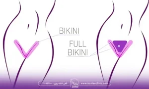 دوتا طرح در کنار هم.که مربوط میشه اندام تناسلی خانم ها که یکی کل بیکینی رو نشون میده و یکی اطراف بیکینی رو نشون میده - نکات مهم برای غلبه بر خجالت از لیزر بیکینی