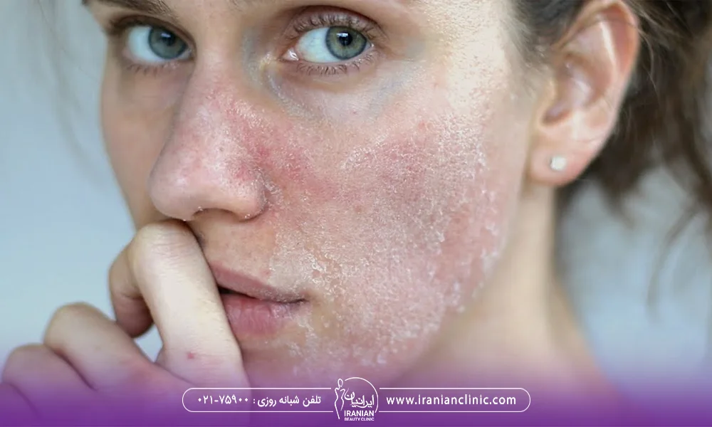 زن جوان که دچار خشکی پوست صورت شده است - عوارض میکرونیدلینگ