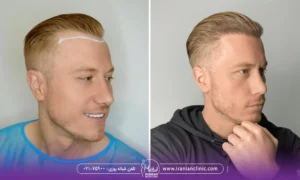 عکس مرد جوان قبل و بعد کاشت مو