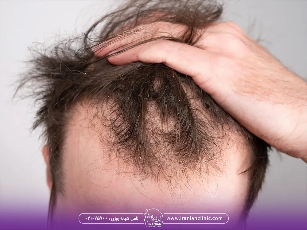 عکس مرد که ریزش موی شدید دارد و دچار طاسی در جلوی سر شده است