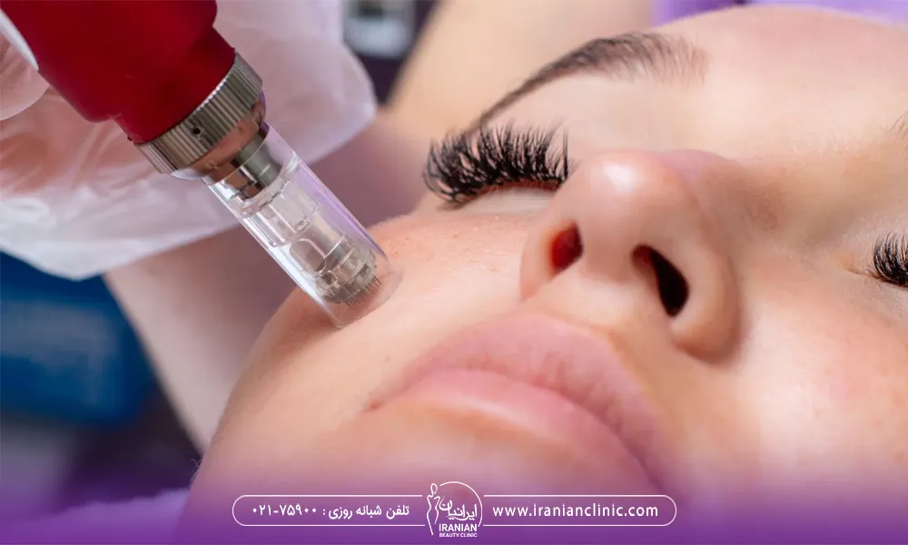 عکس سوزن میکرونیدلینگ روی پوست صورت زن جوان