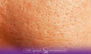 عکس نزدیک از منافذ باز پوست صورت - درمان منافذ باز پوست با میکرونیدلینگ