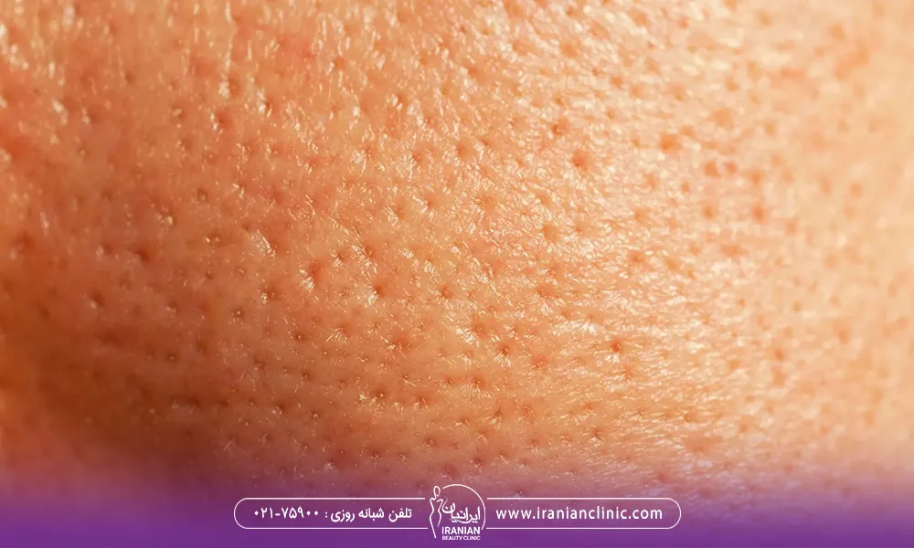 عکس نزدیک از منافذ باز پوست صورت - درمان منافذ باز پوست با میکرونیدلینگ