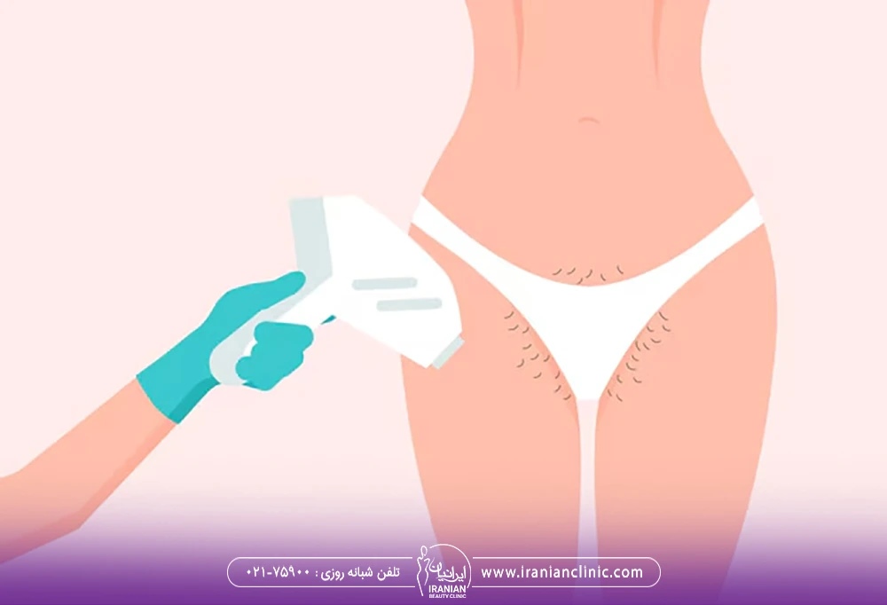 وکتور هندپیس لیزر که اپراتور نواحی شرمگاهی زن را لیزر می کند