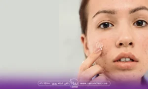 جوش زدن صورت یک خانم بعد از انجام لیزر