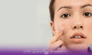 جوش زدن صورت یک خانم بعد از انجام لیزر