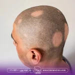 عکس مردی که دچار آلوپسی است - درمان ریزش مو سکه ای