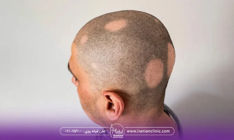 عکس مردی که دچار آلوپسی است - درمان ریزش مو سکه ای