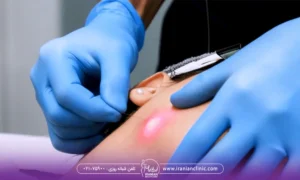 عکس عمل اندولیفت صورت با لیزر اندولیفت