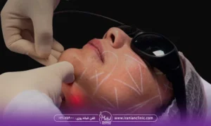 عکس اپراتور دستگاه اندولیفت در حال انجام لیزر اندولیفت روی صورت زن جوان