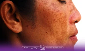 عکس زن که دچار هایپرپیگمانتاسیون یا تیرگی پوست شده است - تیرگی پوست بعد از لیزر